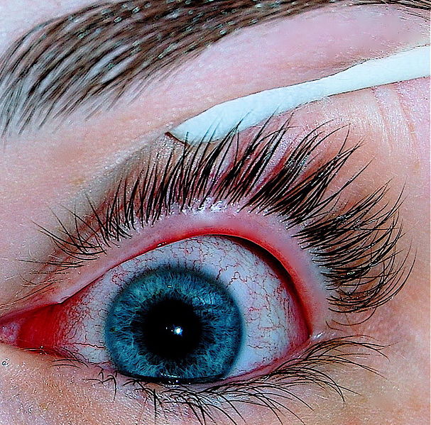 Eye infected with pink eye or conjunctivitis