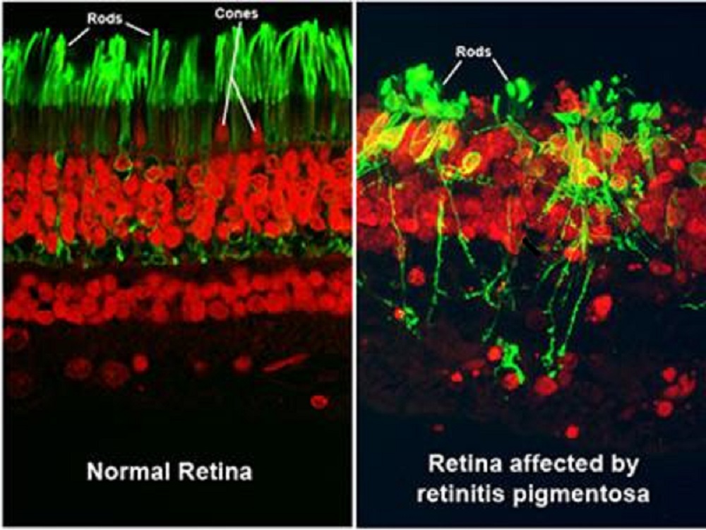 picture of normal retina on theleft and retina with RP  on the right. downloaded from National Eye Institute. mage courtesy of Robert N. Fariss, Ph.D., chief of the NEI Biological Imaging Core, and Ann H. Milam, Ph.D., former professor in the Department of Ophthalmology at the University of Washington.