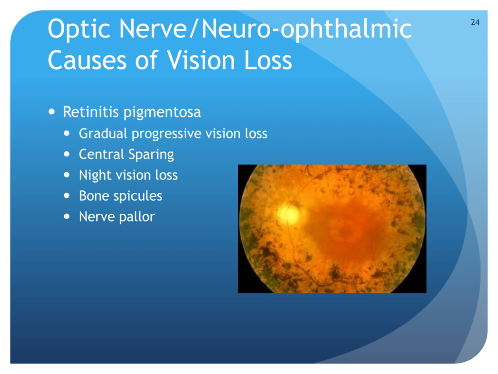 Optic nerve/neuro-ophthalmic causes of vision loss for retinitis pigmentosa
ZEv Shulkin, MD
UT SW Medical Center
. picture of optic nerve