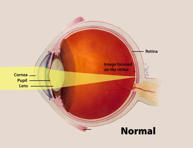 Image of Normal Eye Showing How Images Focus on the Retina licensed as U.S. Government Works, see https://www.usa.gov/government-work 